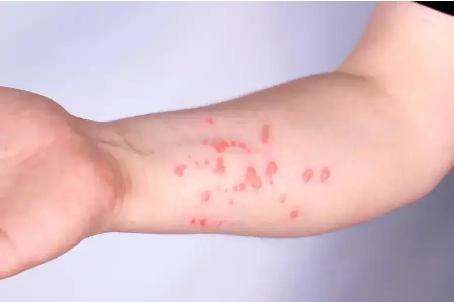 Rio Preto confirma primeiro caso de Mpox em 2026