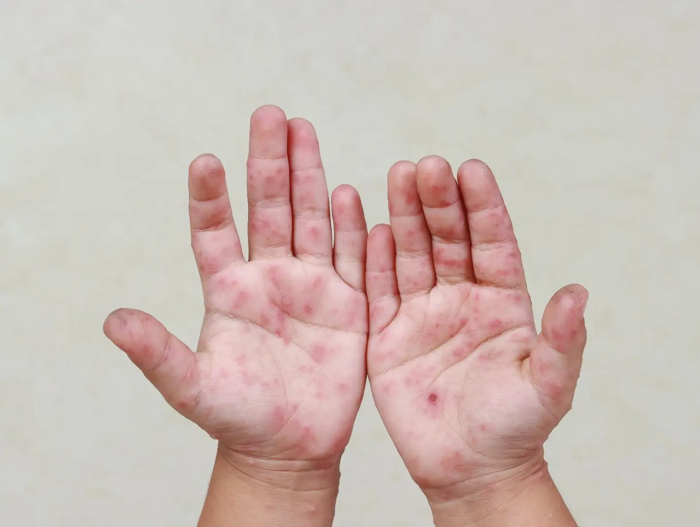 Síndrome mão-pé-boca é contagiosa (Reprodução)