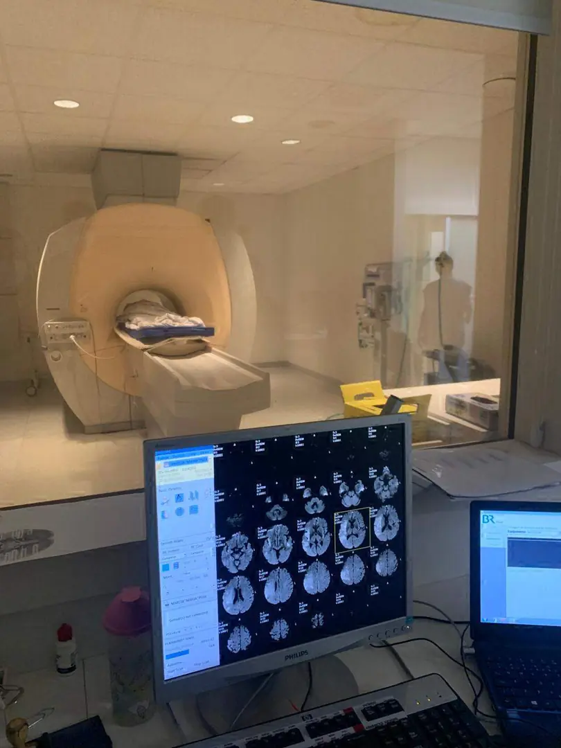 Um a cada 4 internados por AVC tem menos de 60 anos